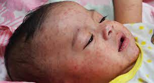 After Mumbai Nagpur now Measles has also entered Akola.